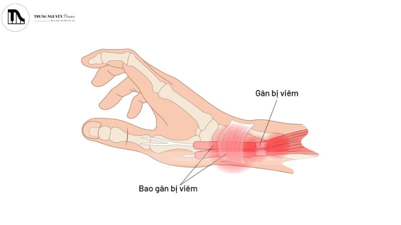 Bài tập giãn cơ phòng tránh chấn thương khi chơi piano giúp giảm đau khi bị viêm gân