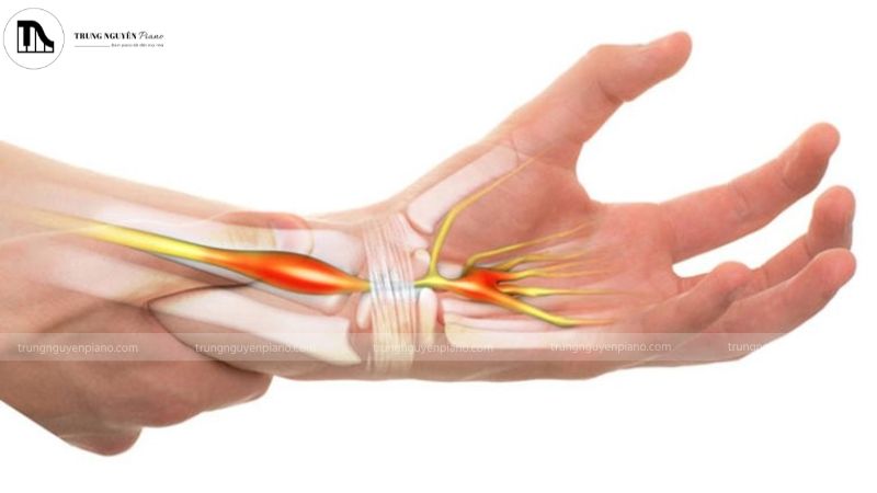  Nên phòng tránh chấn thương piano cơ bản như hội chứng ống cổ tay